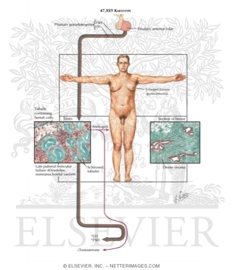 Klinefelter's Syndrome