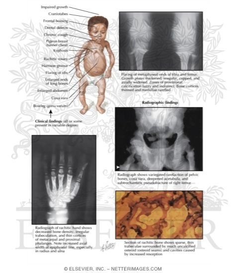 Watermarked preview of labeled image: Clinical Manifestations of Rickets in Childhood