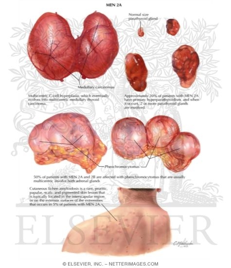 Watermarked preview of labeled image: Multiple Endocrine Neoplasia Type 2