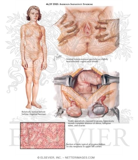 Disorders of Sex Development