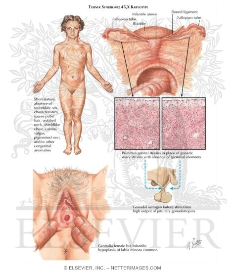 Turner Syndrome (Gonadal Dysgenesis)