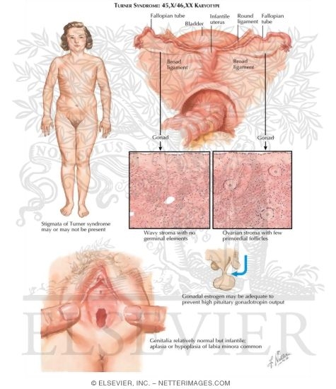 Turner Syndrome Gonadal Dysgenesis