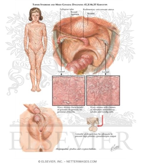 Turner Syndrome (Gonadal Dysgenesis)
