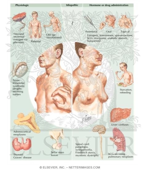 Watermarked preview of labeled image: Gynecomastia