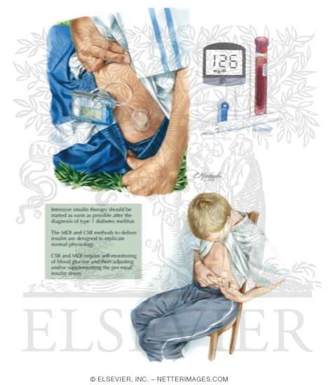 Watermarked preview of labeled image: Treatment of Type 1 Diabetes Mellitus