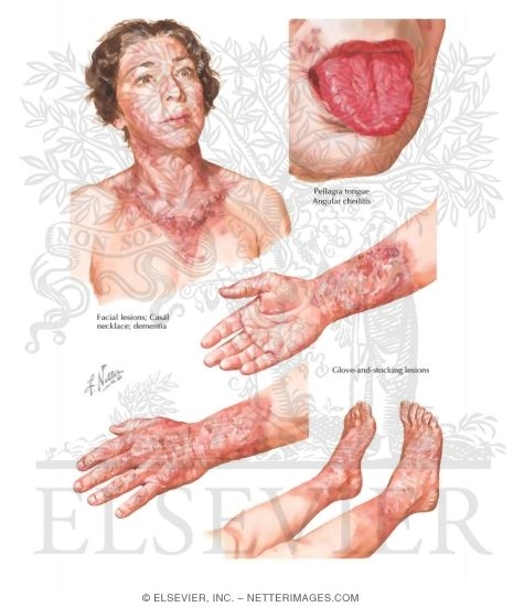 Vitamin B3 Deficiency: Pellagra