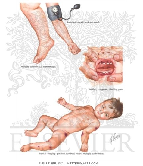 Watermarked preview of labeled image: Vitamin C Deficiency: Scurvy