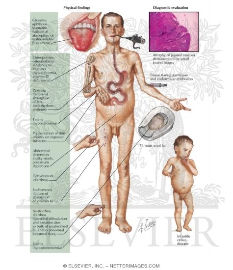 Watermarked preview of labeled image: Celiac Disease and Malabsorption