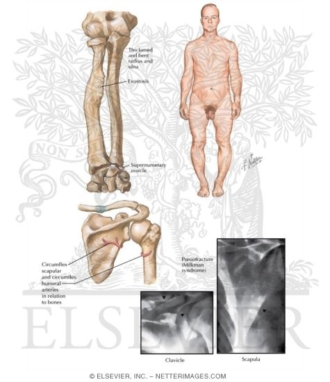 Clinical Manifestations of Osteomalacia In Adults