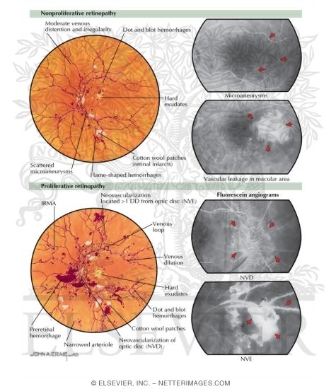 Watermarked preview of labeled image: Diabetic Retinopathy