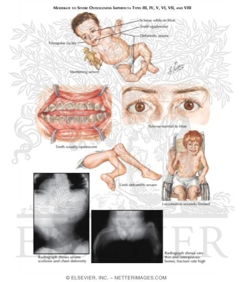 the signs and symptoms of osteogenesis imperfecta Osteogenesis imperfecta symptoms | osteogenesis imperfecta | osteogenesis | osteogenesis stimulator | osteogenesis imperfecta foundation | osteogenesis definiti. the signs and symptoms of osteogenesis imperfecta Osteogenesis imperfecta symptoms | osteogenesis imperfecta | osteogenesis | osteogenesis stimulator | osteogenesis imperfecta foundation | osteogenesis definiti.