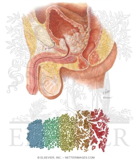 Watermarked preview of unlabeled image: Carcinoma of Prostate I: Epidemiology, Prostate-Specific Antigen, Staging, and Grading