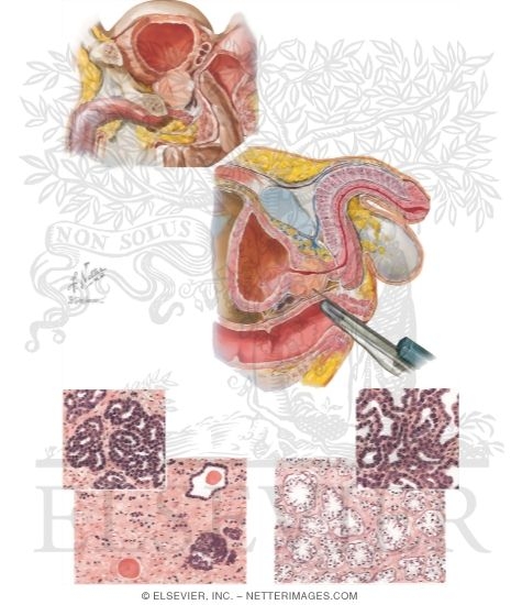 Watermarked preview of unlabeled image: Carcinoma of Prostate III: Diagnosis, Treatment, and Palliation