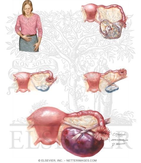 Adnexal Torsion