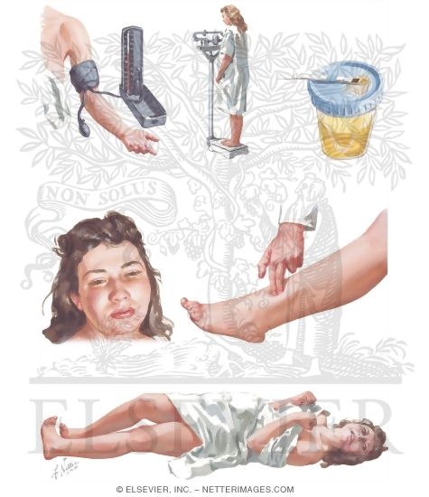 Preeclampsia symptoms 2025