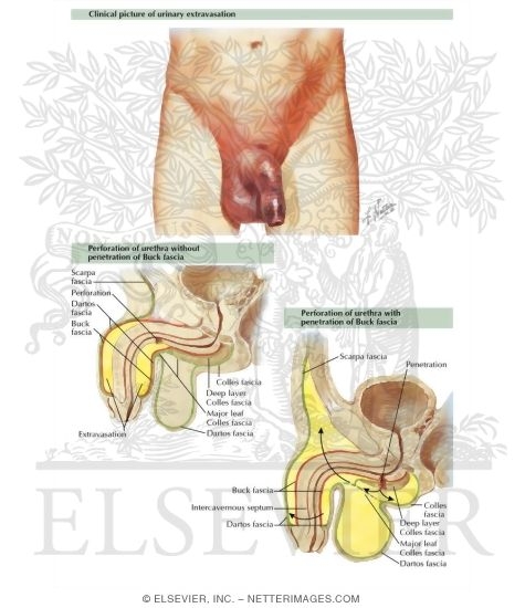 Urinary Extravasation