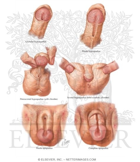 Hypospadia, Epispadia