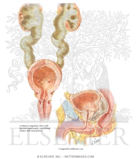 Watermarked preview of labeled image: Congenital Valve Formation, Congenital Cyst