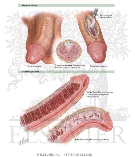 Watermarked preview of labeled image: Peyronie's Disease, Priapism, Thrombosis