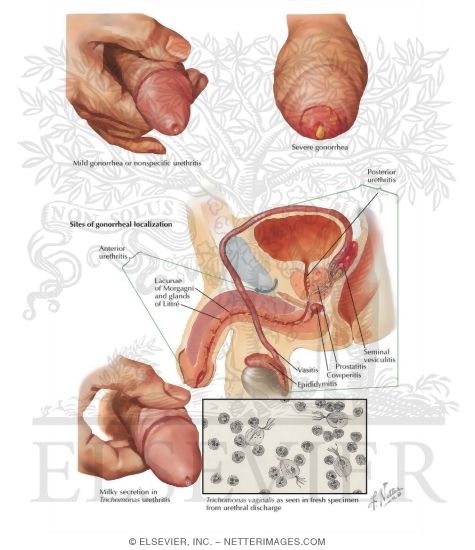 Urethritis In Men