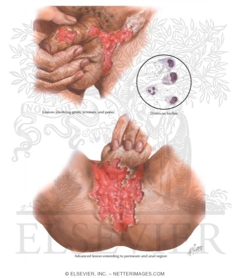Granuloma Inguinale