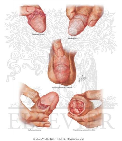 Watermarked preview of labeled image: Warts, Precancerous Lesions, Early Cancer