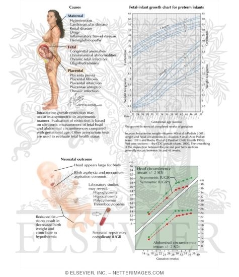 Watermarked preview of labeled image: Intrauterine Growth Restriction