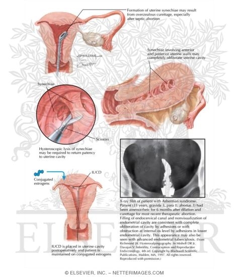 Asherman Syndrome
Asherman's Syndrome (Uterine Synechia)