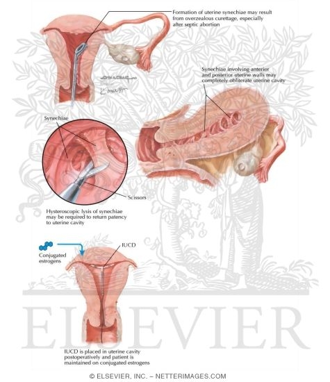 Watermarked preview of labeled image: Asherman Syndrome
Asherman's Syndrome (Uterine Synechia)