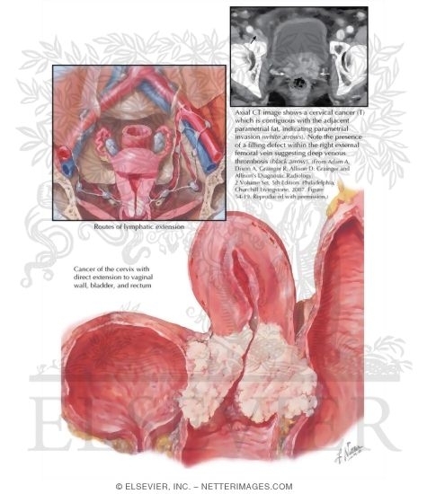Cancer of Cervix III - Extension and Metastases