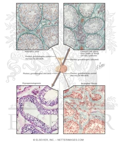 Watermarked preview of labeled image: Testicular Failure VI - Gametogenic Failure