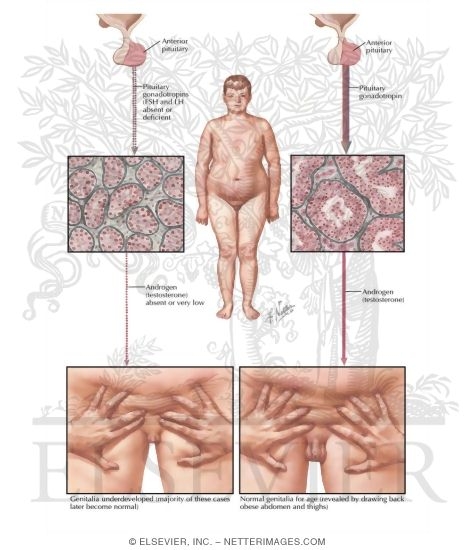 Watermarked preview of labeled image: Testicular Failure V: Delayed Puberty