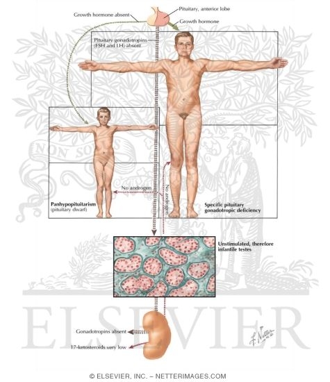 Watermarked preview of labeled image: Pituitary Anterior Lobe Deficiency in Childhood and Adolescence in Boys