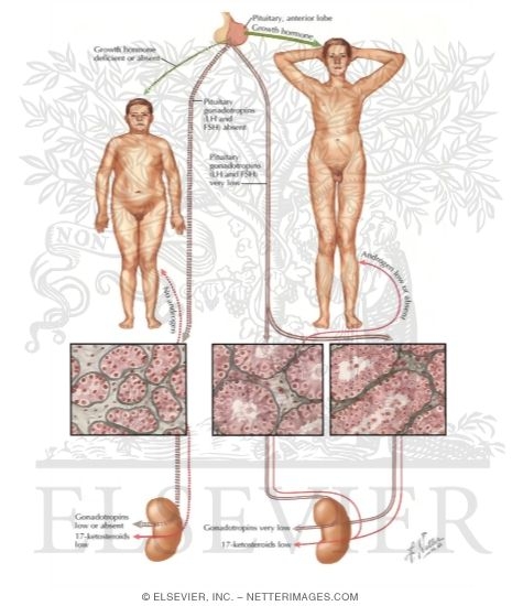 Watermarked preview of labeled image: Testicular Failure III - Variants of Secondary Hypogonadism