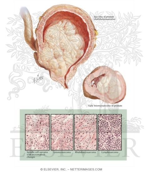 Watermarked preview of labeled image: Sarcoma of Prostate