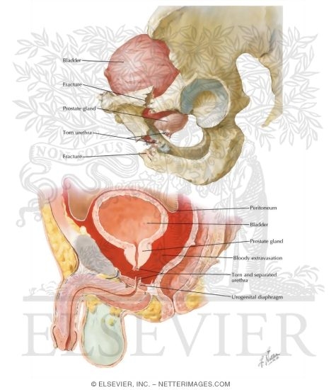 Watermarked preview of labeled image: Trauma of the Pelvis