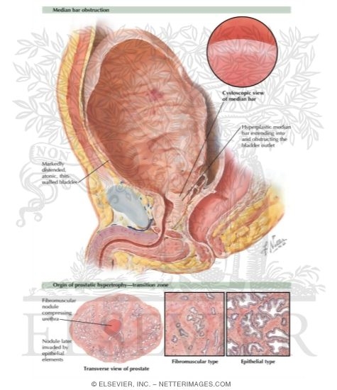 Benign Prostatic Hypertrophy I - Histologic Structure, Median Bar