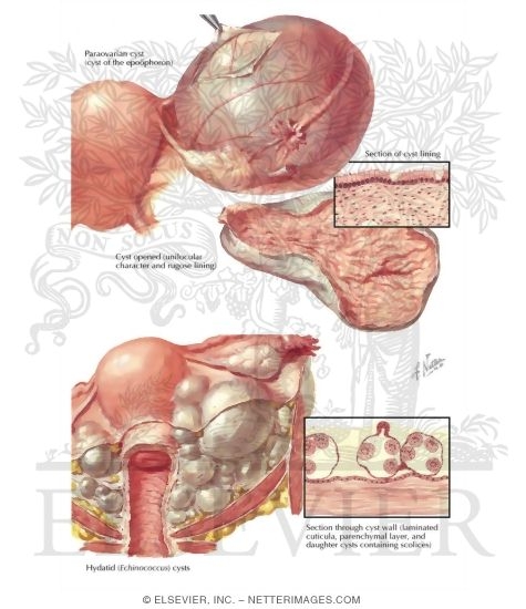 Paraovarian Or Epoophoron Cyst