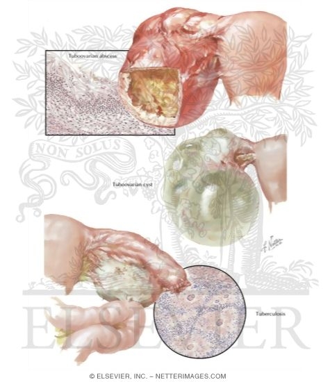 Watermarked preview of labeled image: Ovarian Infections