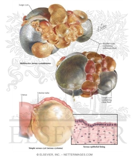 Serous Cystoma, Serous Cystadenoma