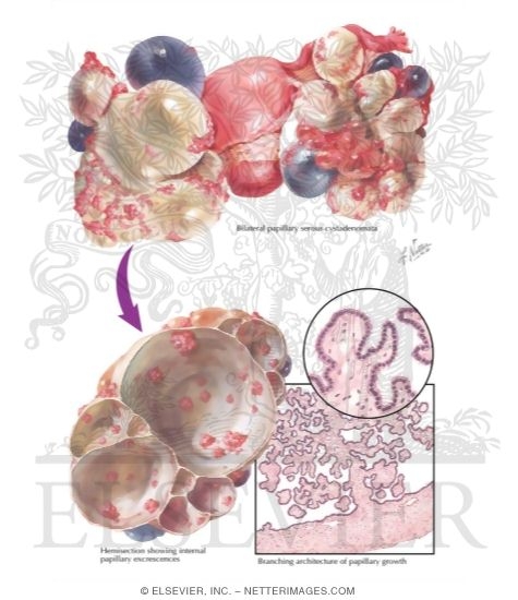 Papillary Serous Cystadenoma
