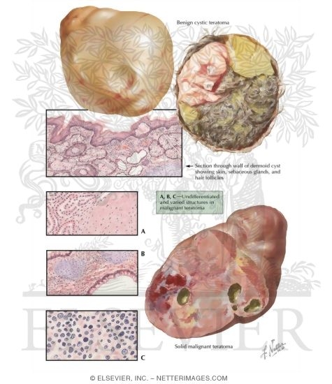 Watermarked preview of labeled image: Teratoma, Dermoid Cyst, Solid Teratoma