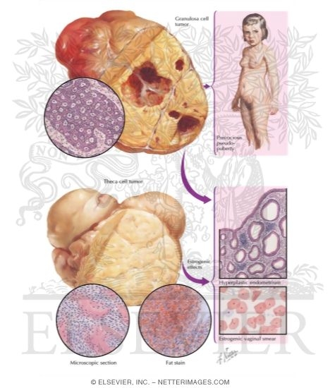 Watermarked preview of labeled image: Feminizing Neoplasms, Granulosa Cell Tumor, Theca Cell Tumor