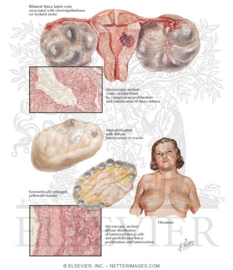 Watermarked preview of labeled image: Endocrinopathies Associated with Ovarian Pathology I - Theca Lutein Cysts, Masculinization with Diffuse Luteinization