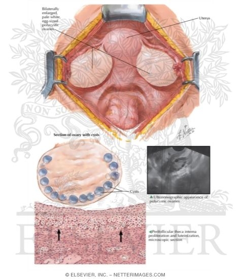 Endocrinopathies Associated With Ovarian Pathology II - Stein-Leventhal Syndrome