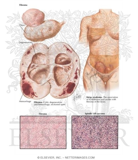 Watermarked preview of labeled image: Stromatogenous Neoplasms - Fibroma, Meigs' Syndrome, Sarcoma