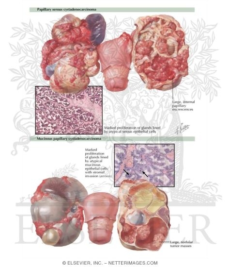 Watermarked preview of labeled image: Carcinoma - Primary Cystic Carcinoma, Primary Solid Carcinoma, Secondary Ovarian Carcinoma