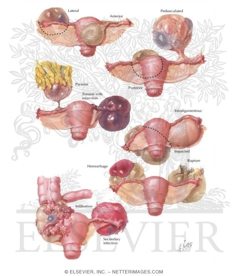 Watermarked preview of labeled image: Diagnosis of Ovarian Neoplasms