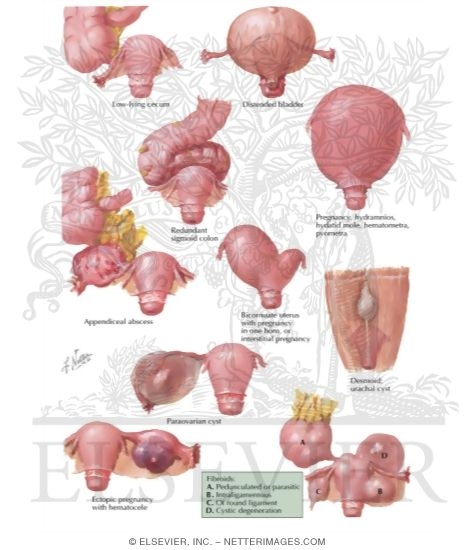 Conditions Simulating Ovarian Neoplasms - Differential Diagnosis