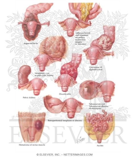 Watermarked preview of labeled image: Conditions Simulating Ovarian Neoplasms - Differential Diagnosis